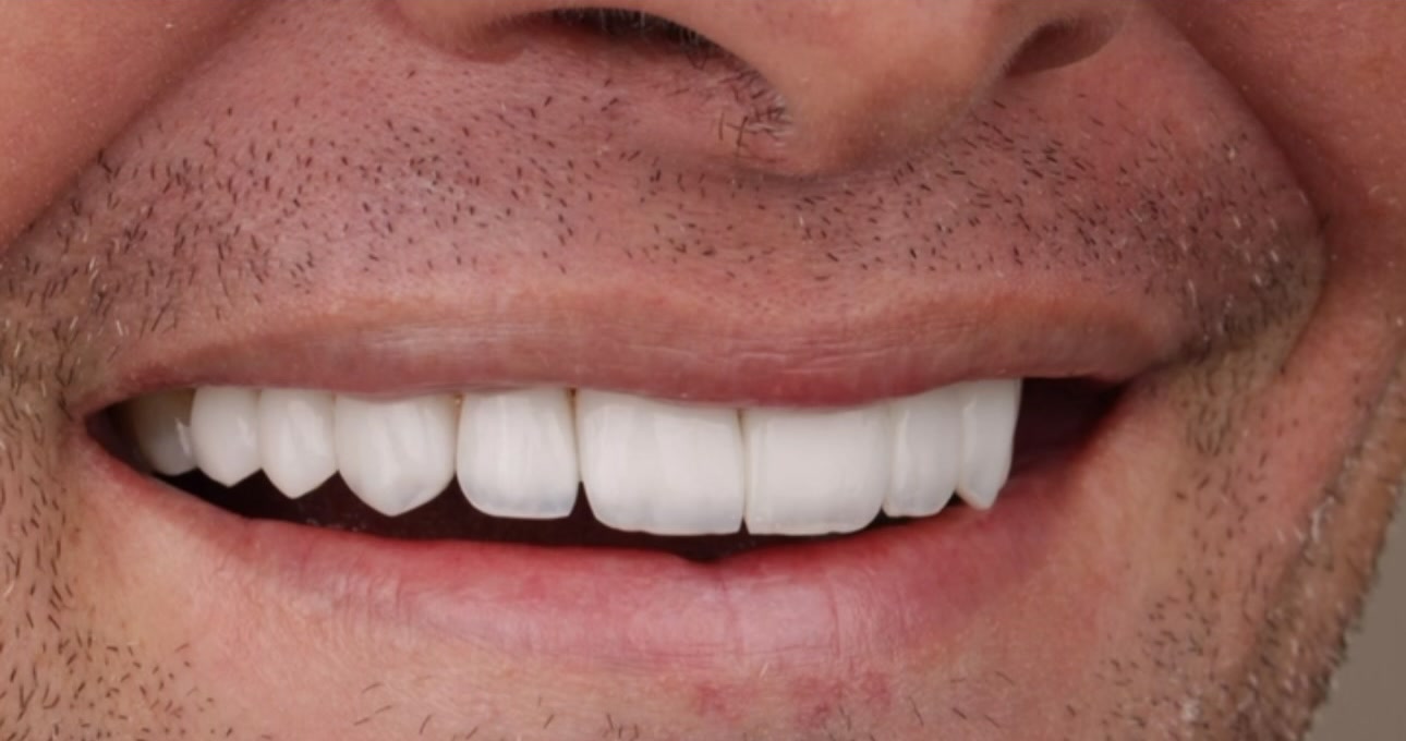 Sorriso depois do tratamento com lentes em resina, caso publicado pela Dra. Gezia Rios