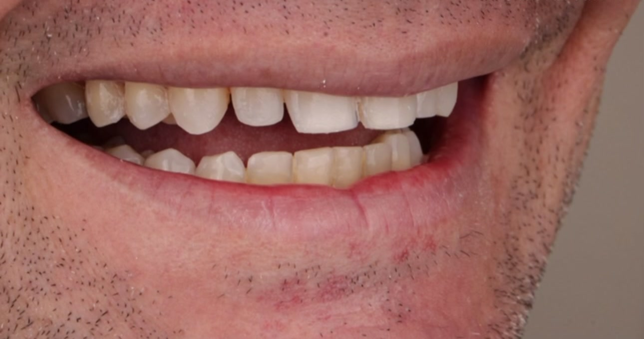 Sorriso antes do tratamento, caso publicado pela Dra. Gezia Rios