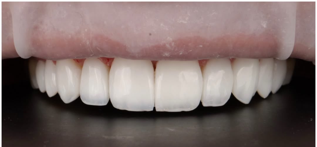 Sorriso depois do tratamento com lentes em resina, caso publicado pela Dra. Gezia Rios