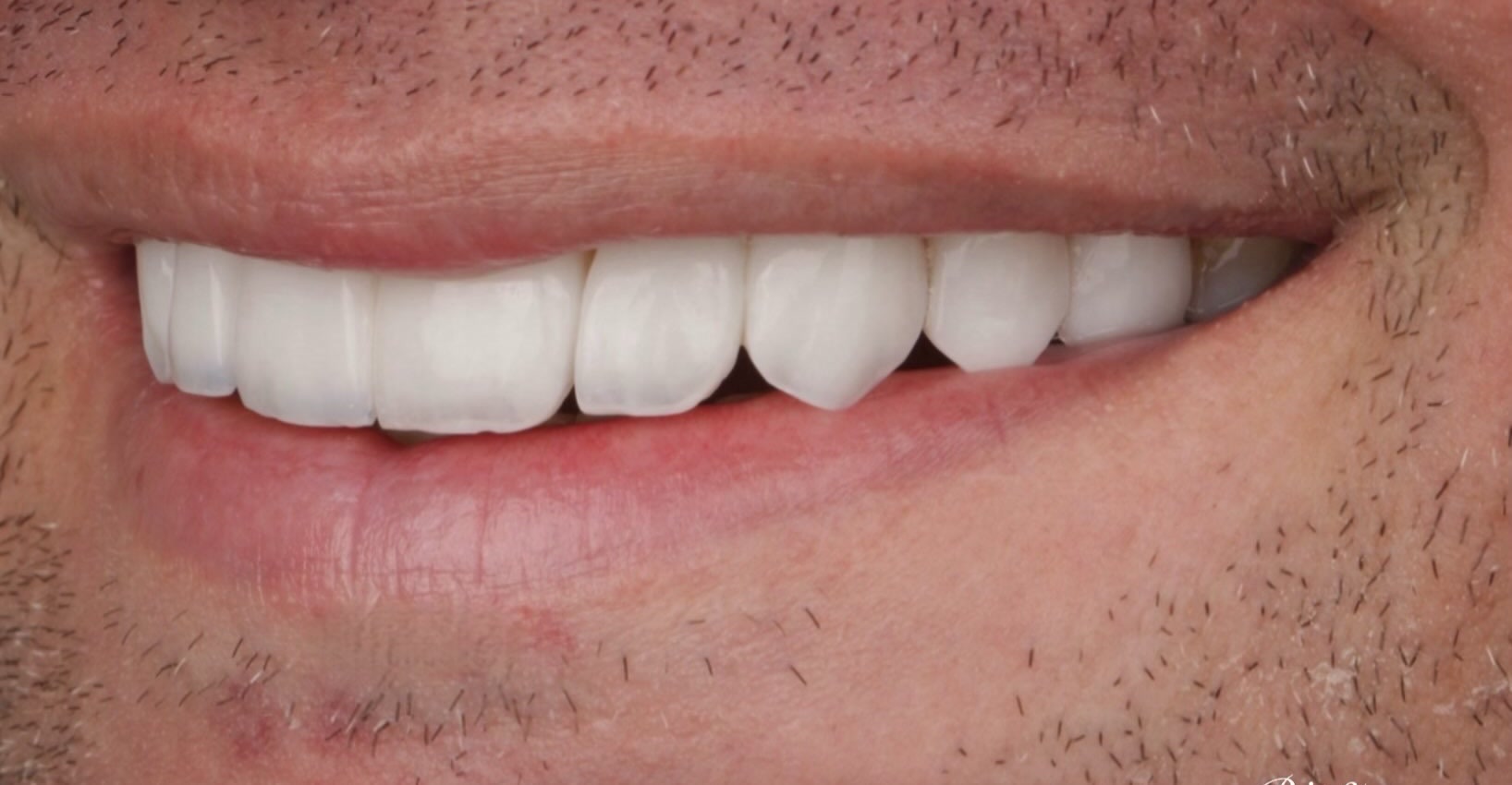 Sorriso depois do tratamento com lentes em resina, caso publicado pela Dra. Gezia Rios
