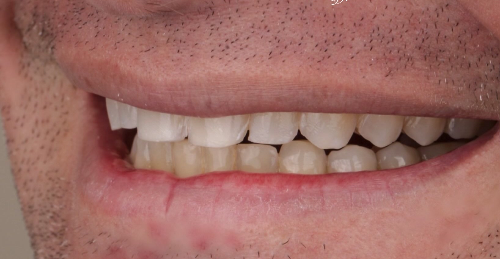 Sorriso antes do tratamento, caso publicado pela Dra. Gezia Rios